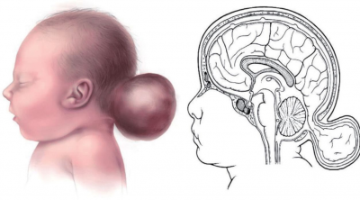 Mengenal Penyakit Langka Encephalocele, Gejala, Penyebab, dan Pengobatan
